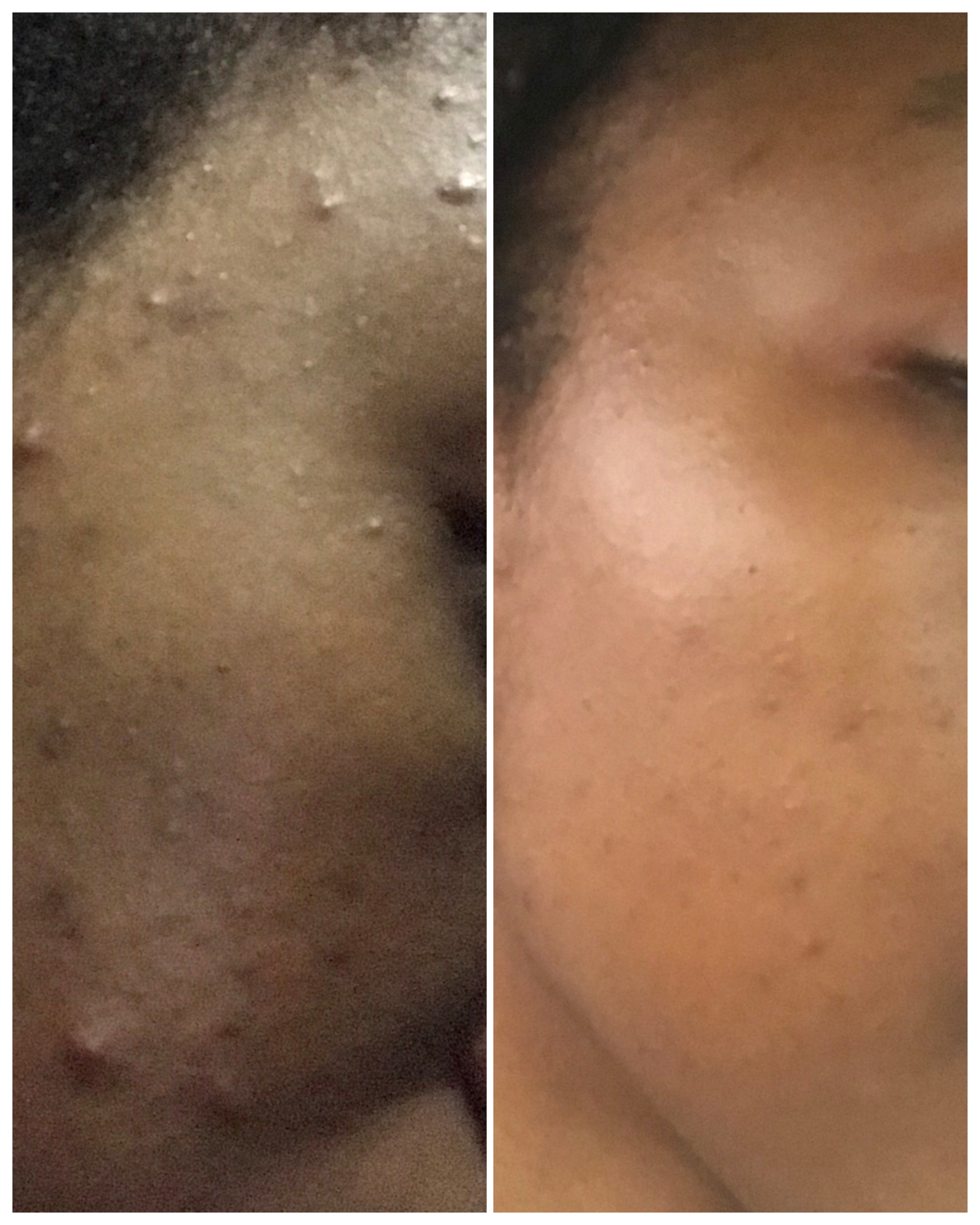 Cassie Daves before and after with Korean skincare